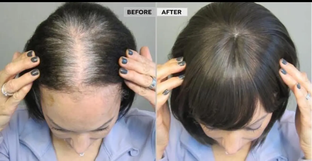 Hair loss before and after treatment.